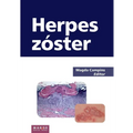 Herpes zóster - Paperback